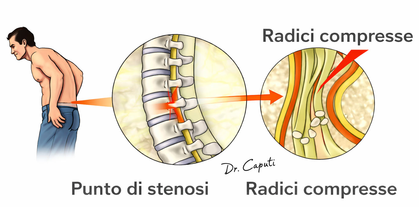 Schema illustrativo della stenosi lombare con restringimento del canale vertebrale