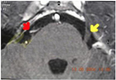 Risonanza magnetica ad alta definizione del trigemino con riferimenti anatomici clinici