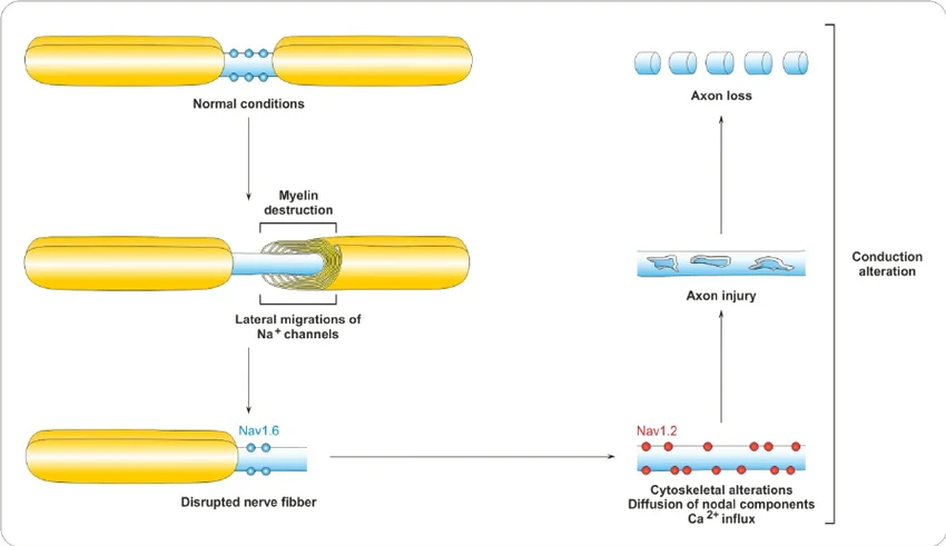 Processo di demielinizzazione delle fibre del trigemino