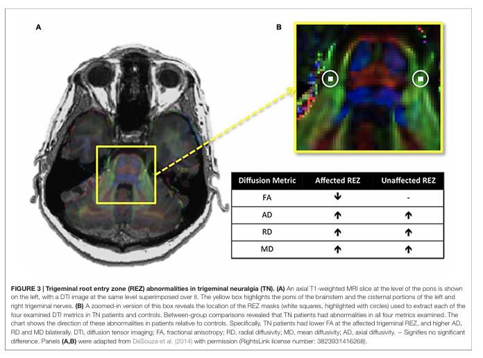 Root entry zone del trigemino e mielina
