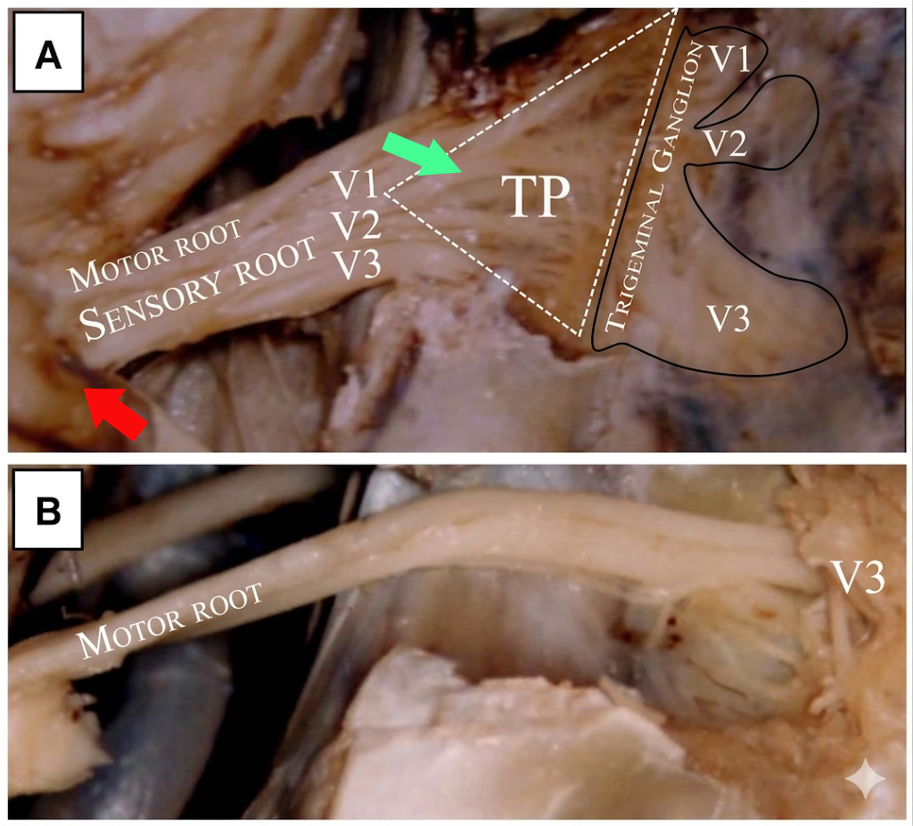 Dettaglio anatomico del segmento prossimale della radice trigeminale