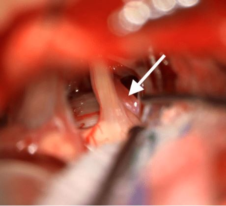 Conflitto neurovascolare del trigemino