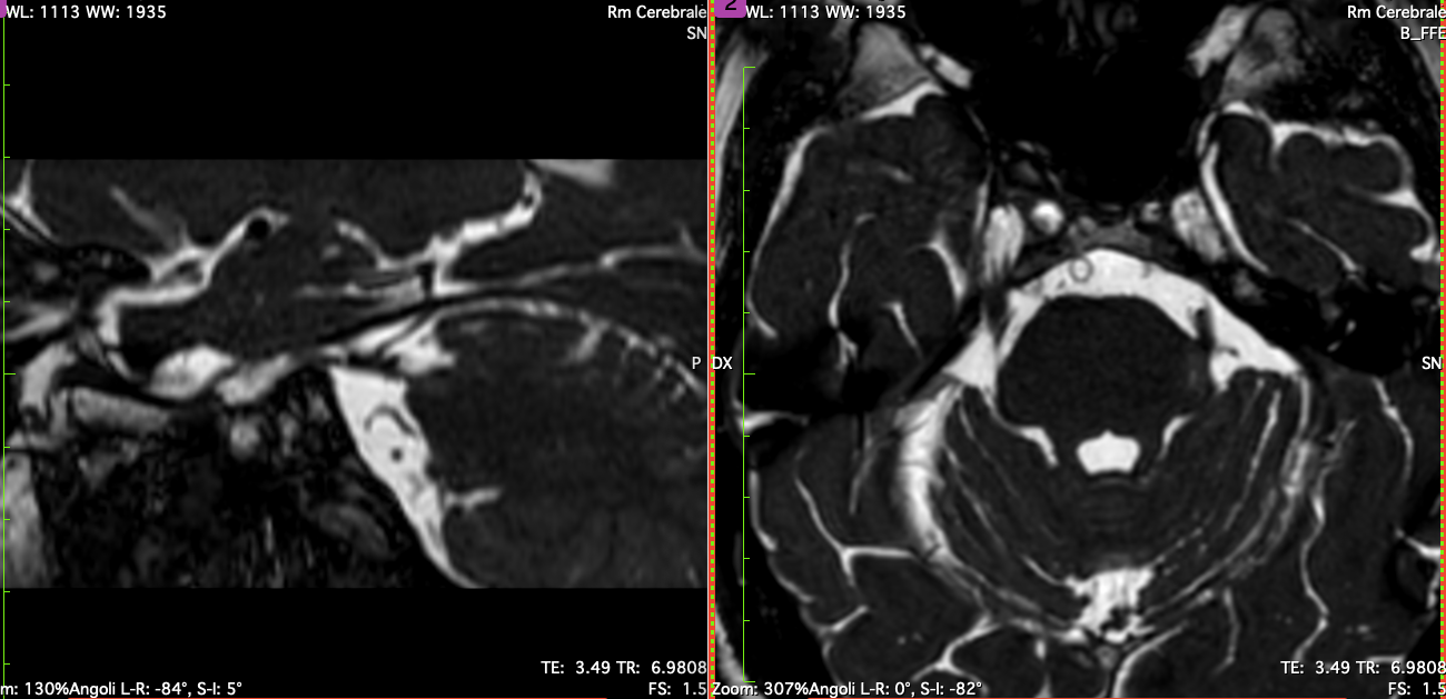 Conflitto neurovascolare del trigemino in RM con immagini assiali e sagittali del contatto tra arteria cerebellare superiore e radice del nervo trigemino alla root entry zone