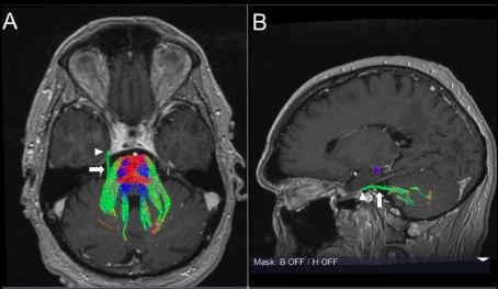 Trattografia del nervo trigemino alla root entry zone (REZ) con ricostruzione DTI su risonanza magnetica, visualizzazione delle fibre nel punto di ingresso nel tronco encefalico
