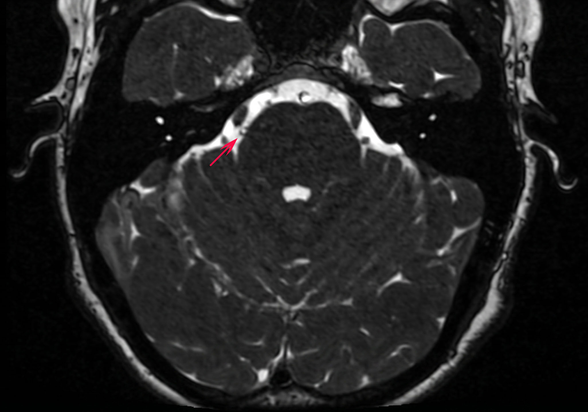 Root entry zone del trigemino e conflitto neurovascolare alla risonanza magnetica