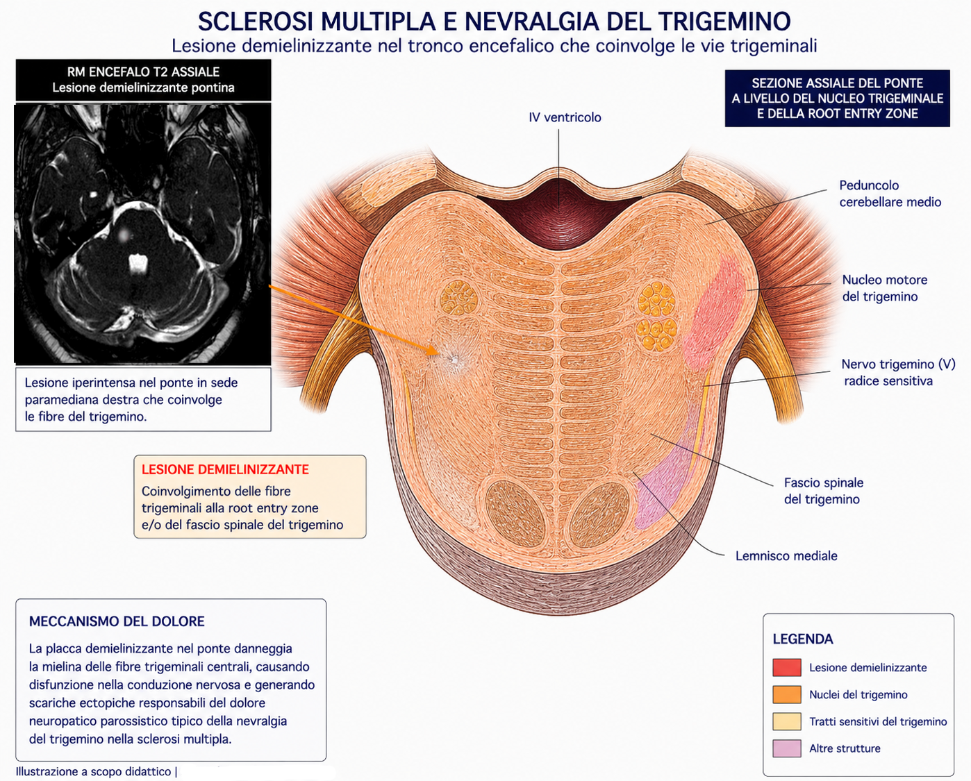 Schema illustrativo del coinvolgimento delle vie trigeminali nella sclerosi multipla